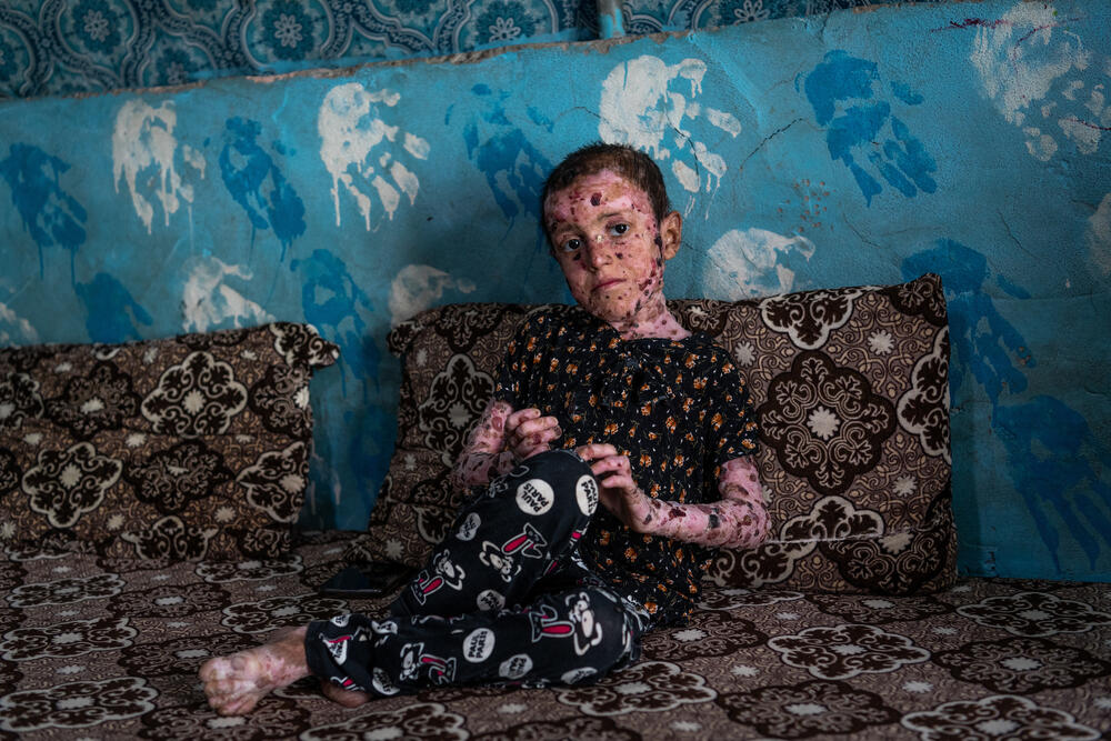 Maya, merch ddeg oed o Iraq sy’n dioddef o glefyd Epidermolysis Bullosa