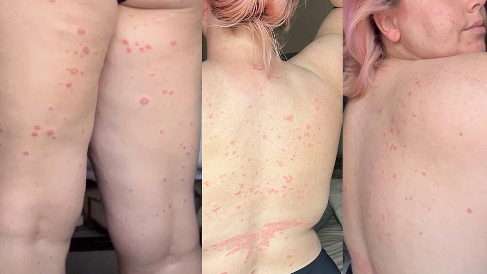 Y psoriasis ar hyd corff Mari Gwenllian